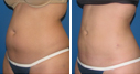 Before & After Photos
